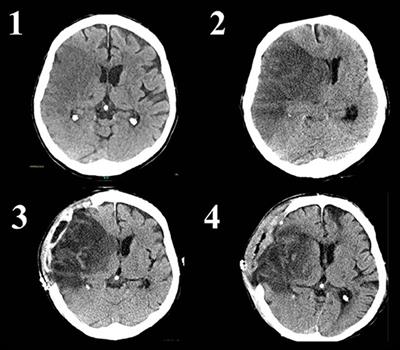 Role of Decompressive Craniectomy in Ischemic Stroke